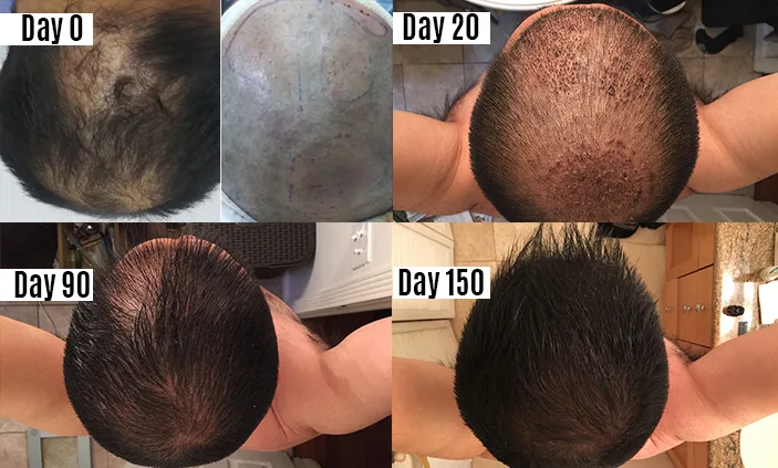 hair transplant in mexico

